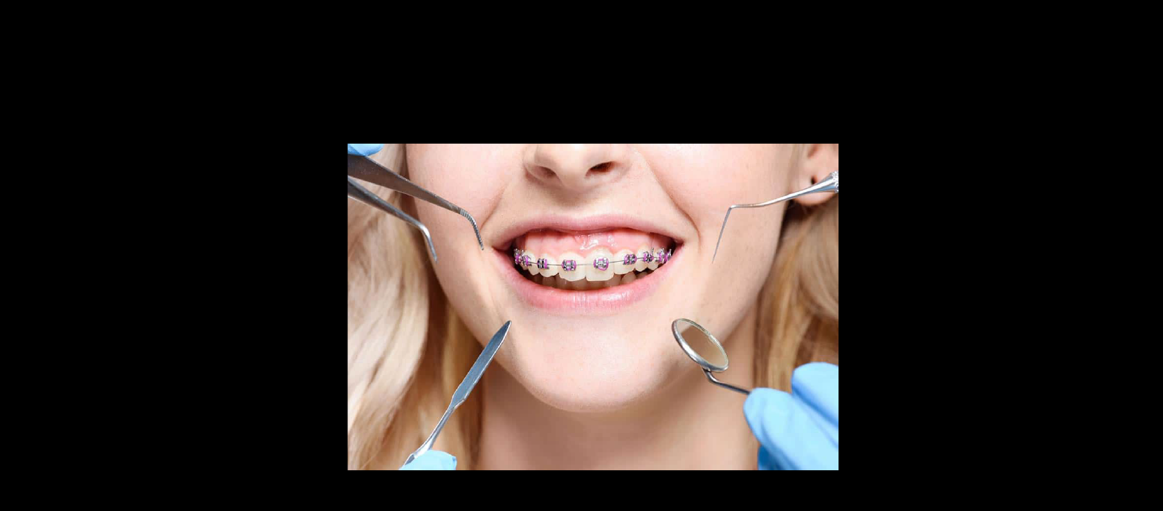 Orthodontics example #1 in Happy Light Dental, Hawthorne, CA, 90250