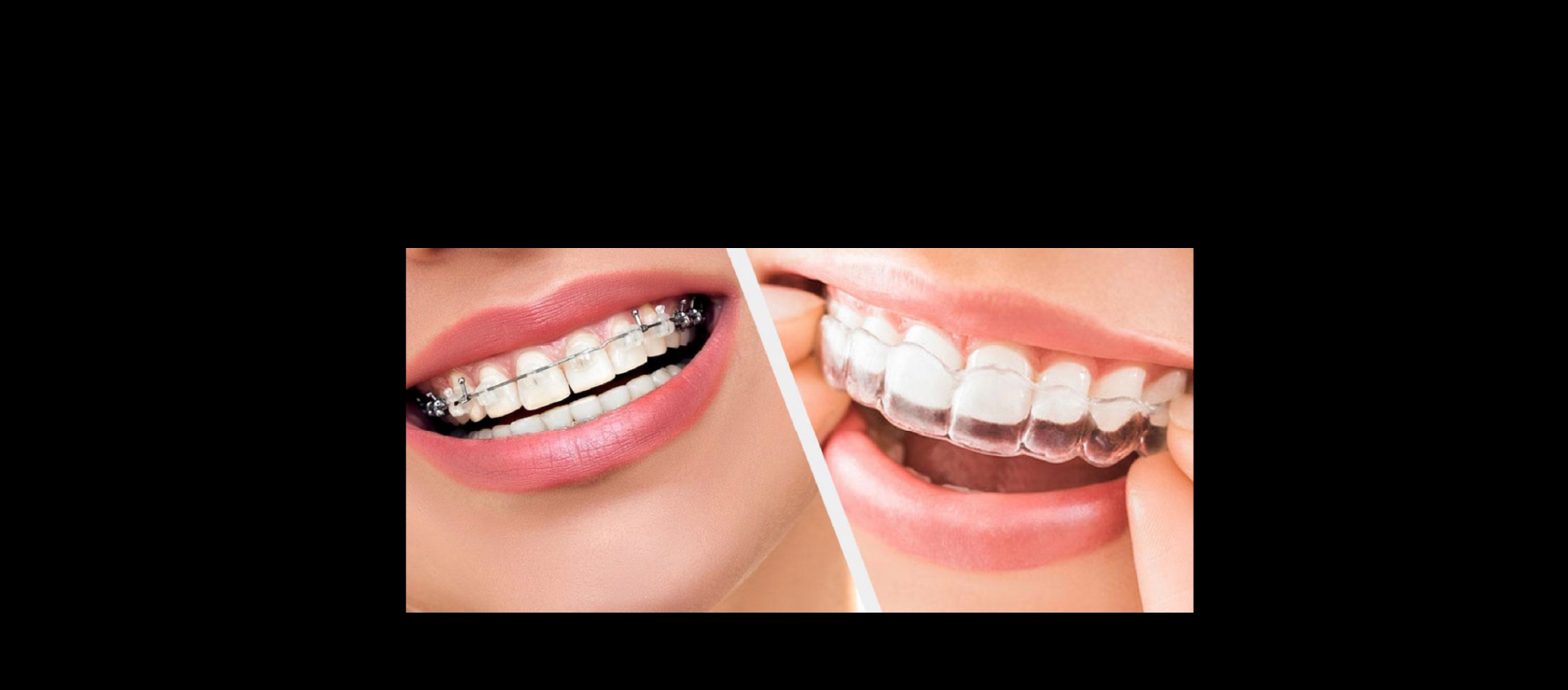 Orthodontic example #2 in Happy Light Dental, Hawthorne, CA, 90250