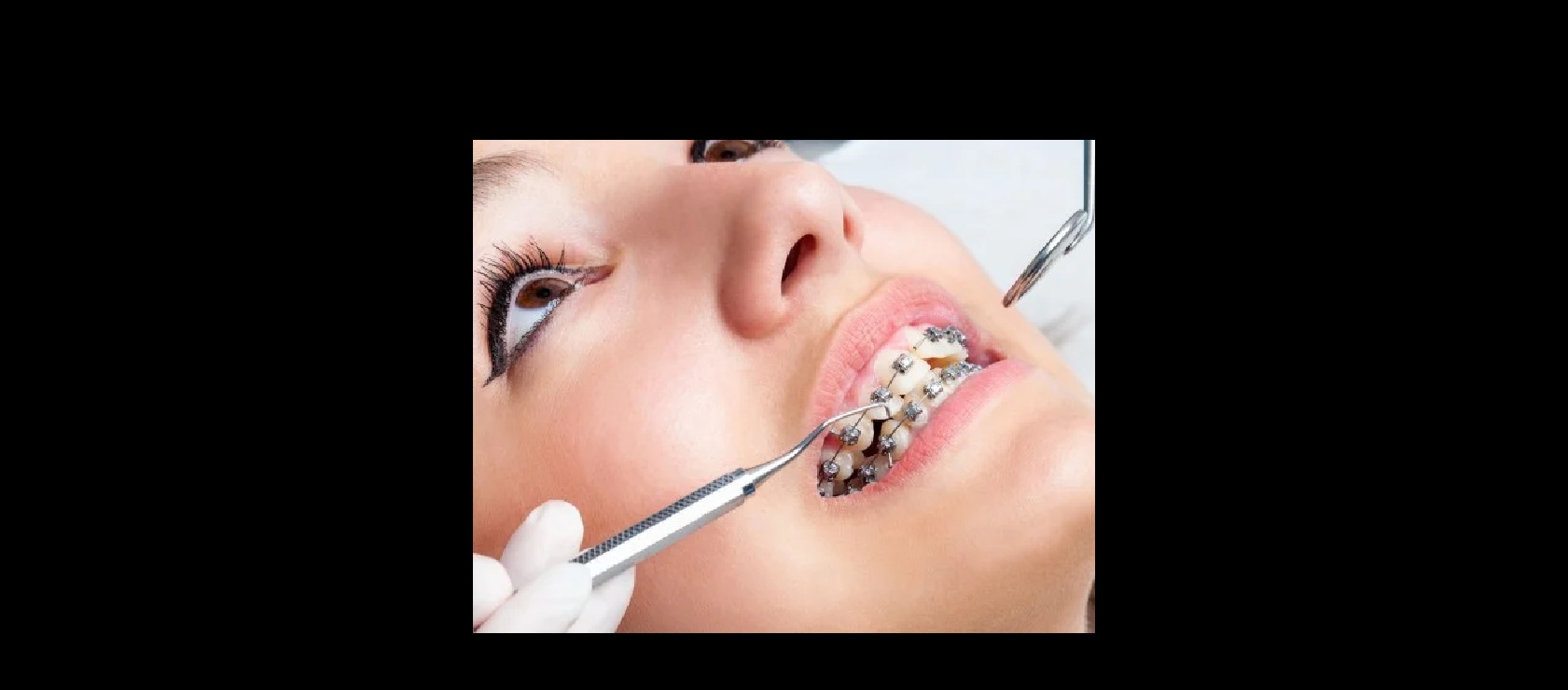 Orthodontic example #3 in Happy Light Dental, Hawthorne, CA, 90250