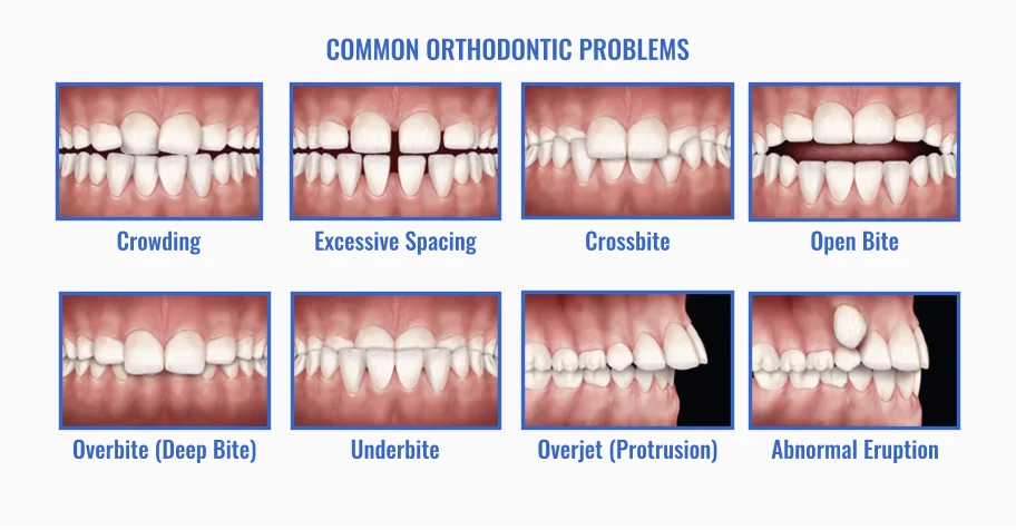 Problemas ortodónticos comunes: apiñamiento, espacios, mordida cruzada, mordida abierta, sobremordida, mordida invertida, resalte, erupción anormal