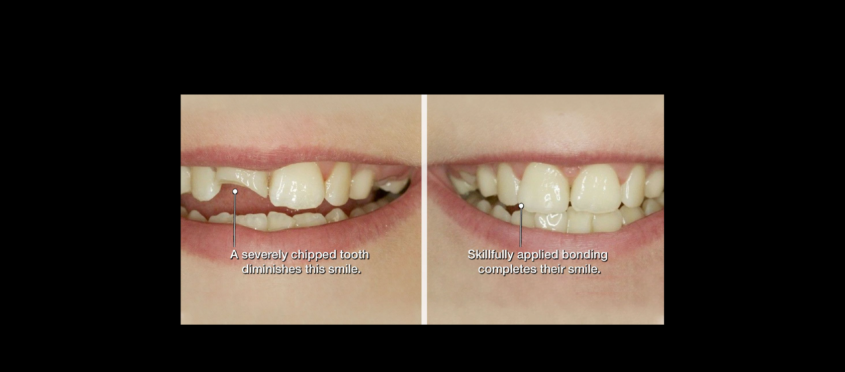 Dental Bonding in Happy Light Dental, Hawthorne CA, 90250