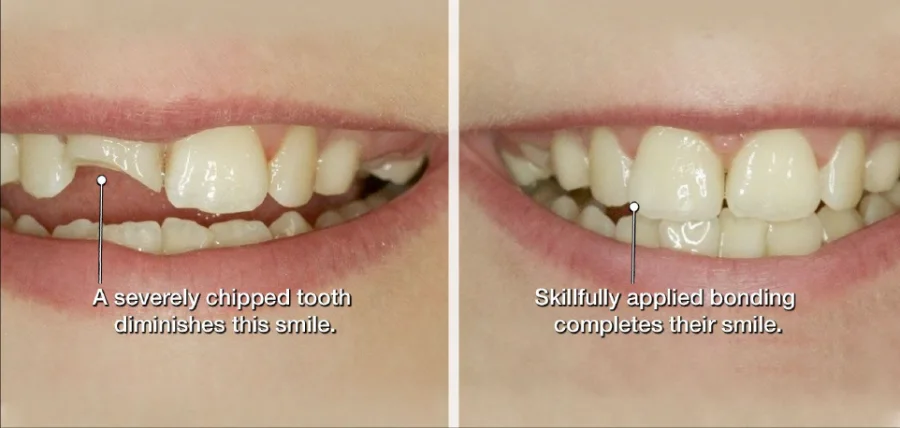 Dental bonding on a front tooth