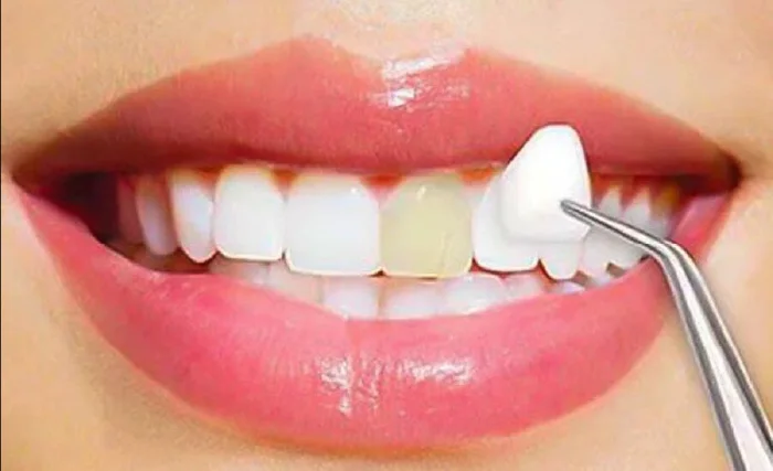 Smile makeover consultation