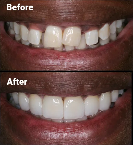 Gum contouring before and after