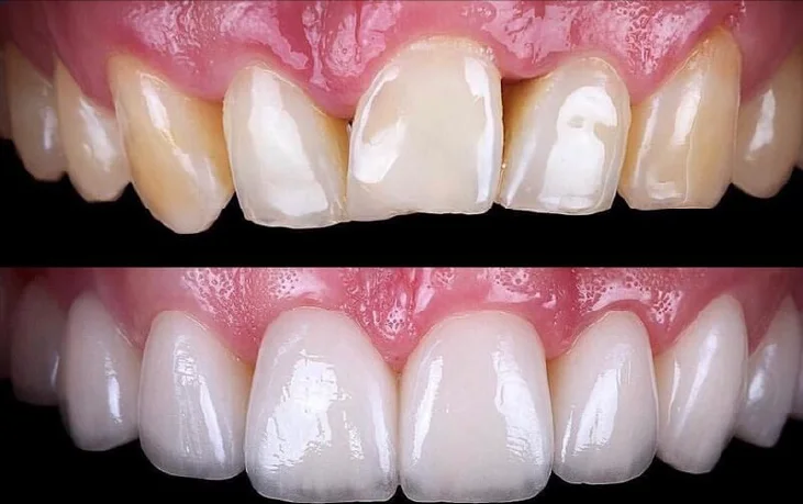 Porcelain veneer being placed