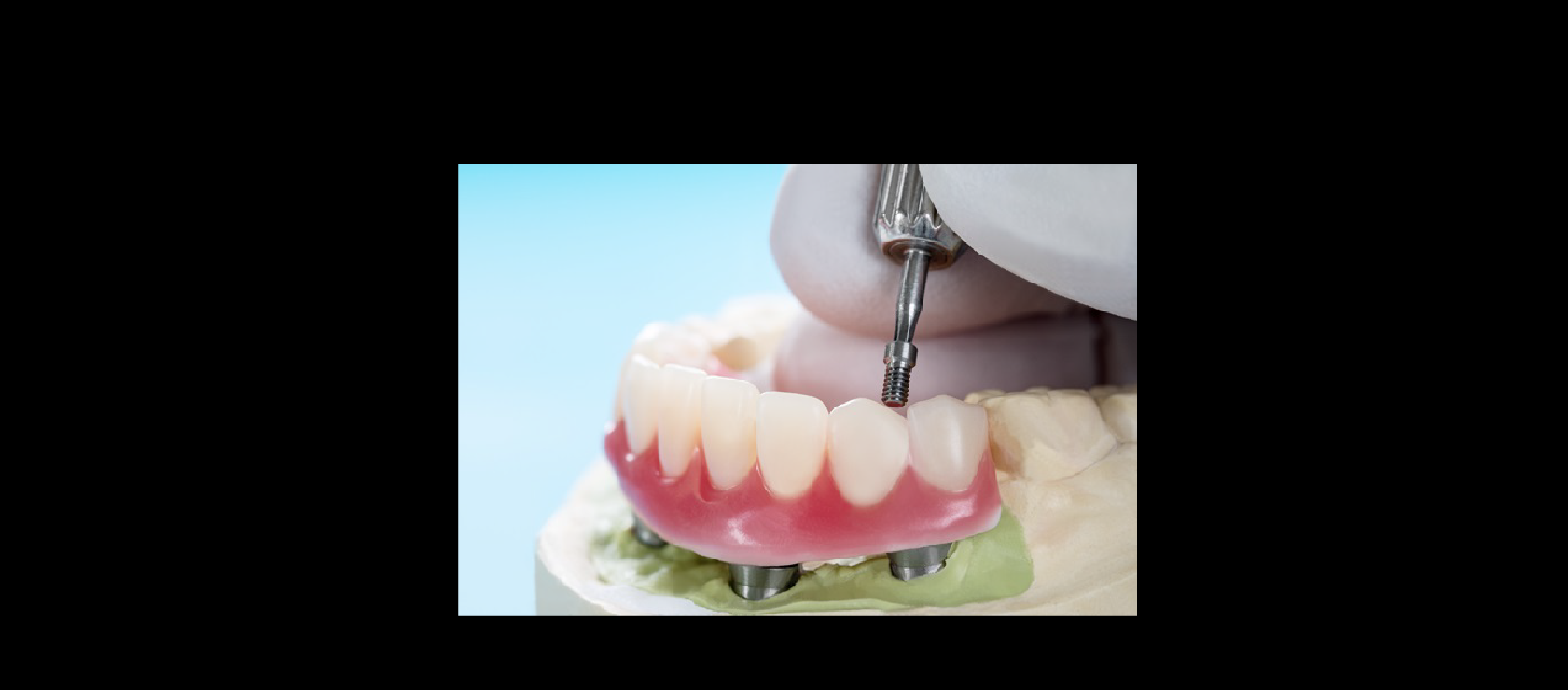 Implant Restrained Dentures Sample in Happy Light Dental, Hawthorne, CA, 90250