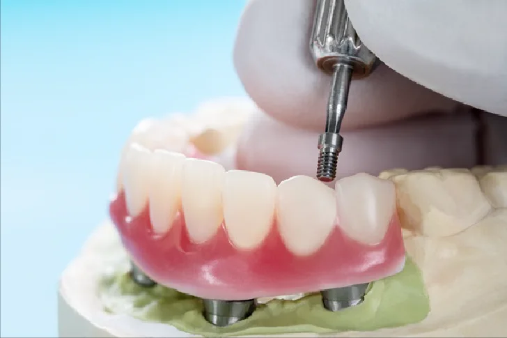 Implant-supported denture