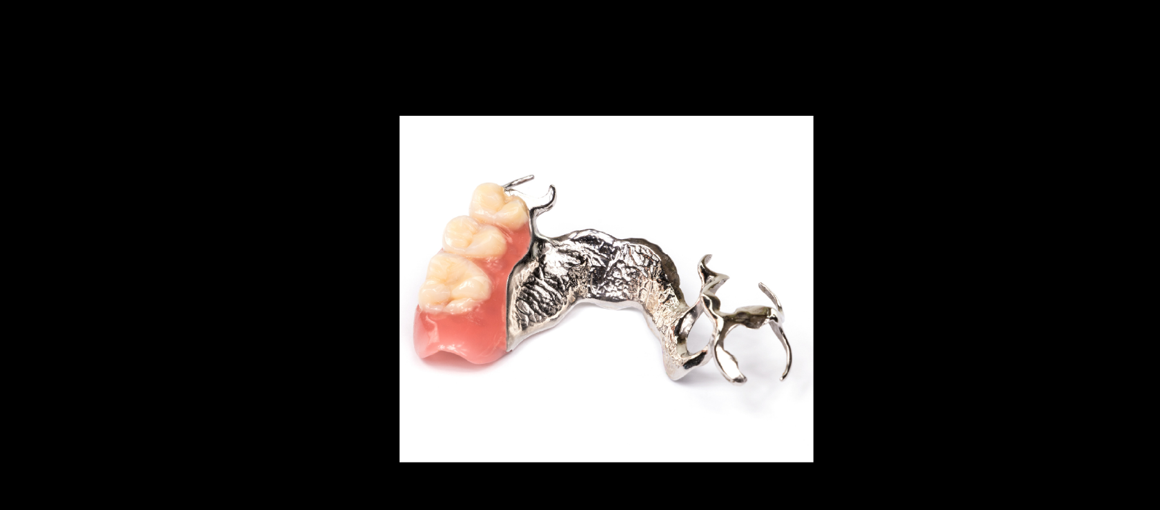 Partial Denture Example in Happy Light Dental, Hawthorne, CA, 90250
