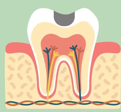 Diente con una caries
