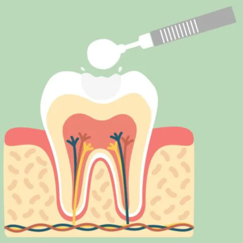 Eliminación de la caries