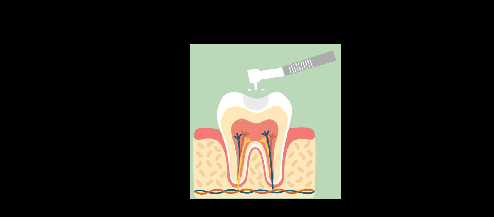 Dental Fillings: Step2 - Removing Decay in Happy Light Dental, Hawthorne, CA, 90250