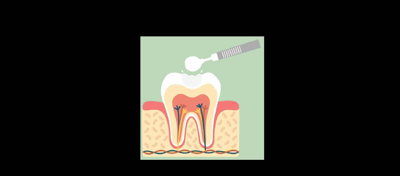 Dental Fillings: Step3 - Applying Dental Filling in Happy Light Dental, Hawthorne, CA, 90250