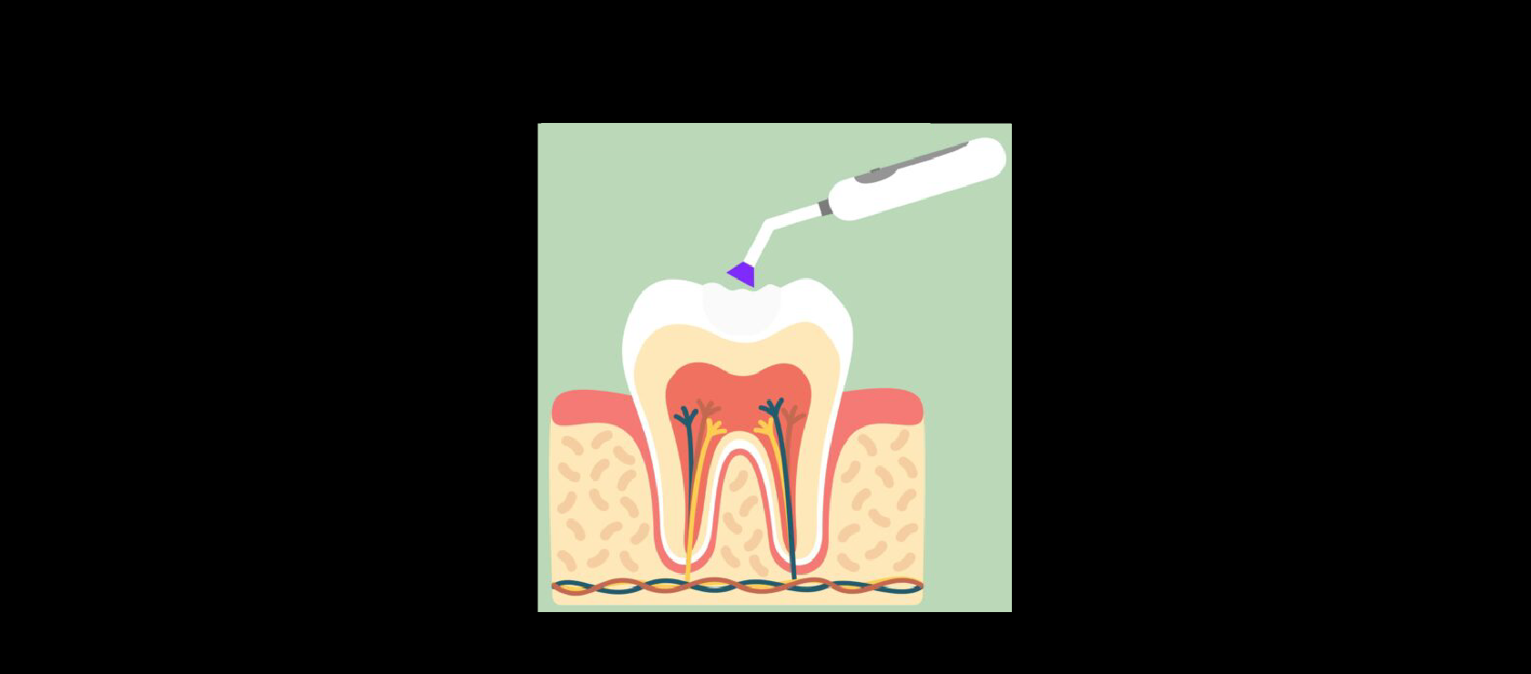 Dental Fillings: Step4 - Curing the Filling in Happy Light Dental, Hawthorne, CA, 90250