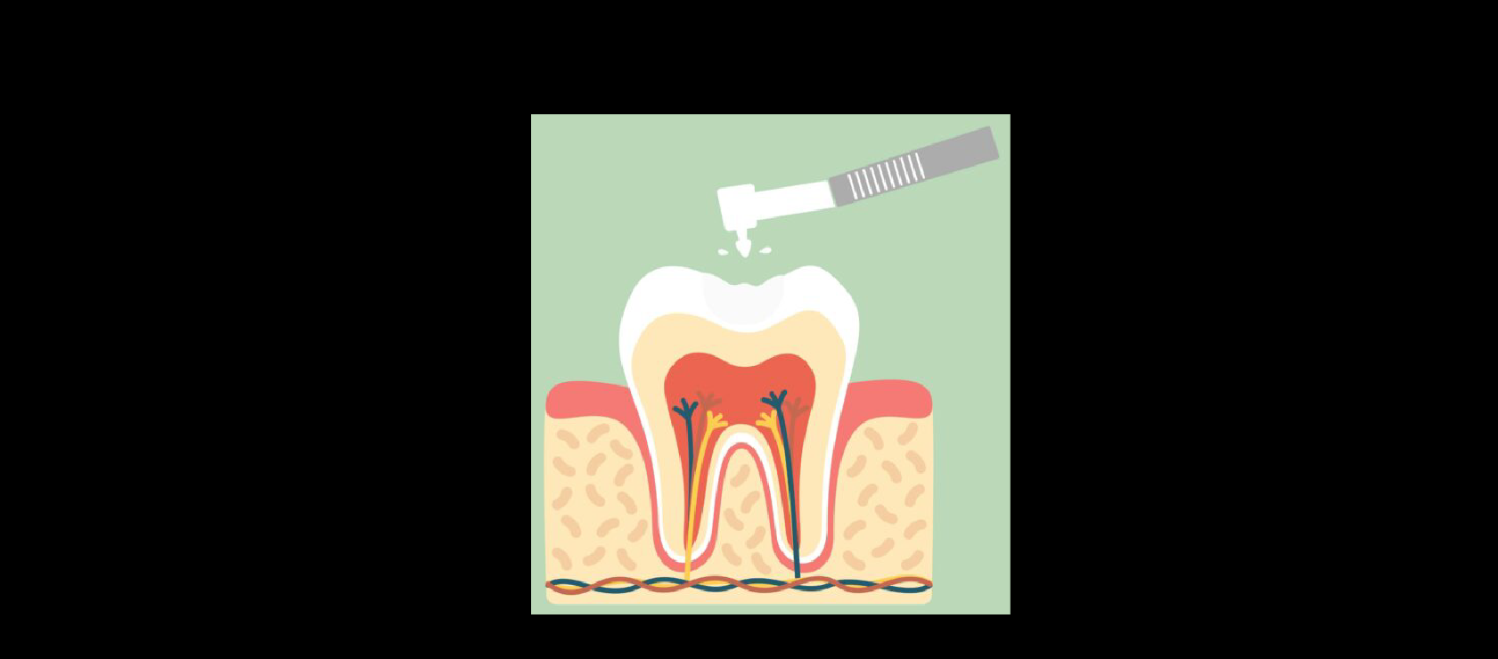Dental Fillings: Step5 - Post-Procedure Care in Happy Light Dental, Hawthorne, CA, 90250