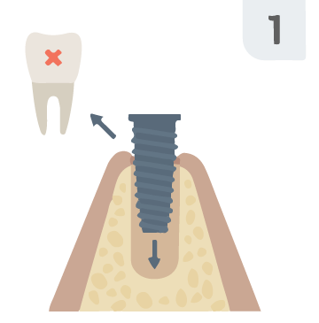 Step 1: implant placement