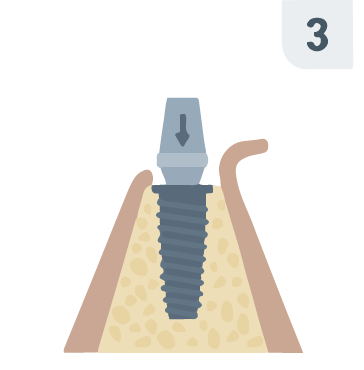 Step 3: abutment placement