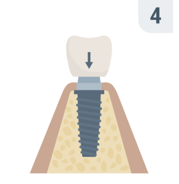 Step 4: crown attachment
