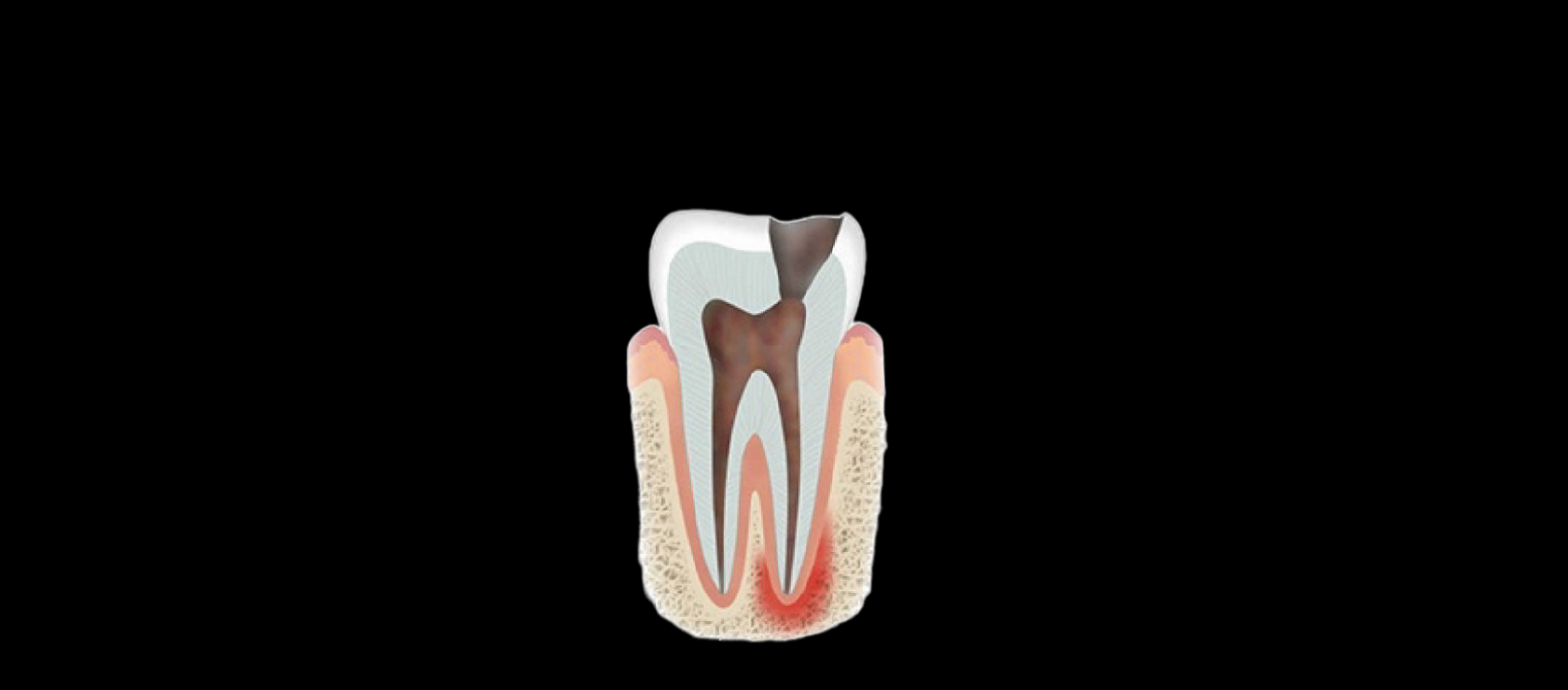 Root Canal: Step1- Diagnosis in Happy Light Dental, Hawthorne, CA, 90250