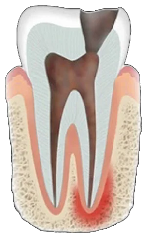 Infected tooth with inflamed nerve