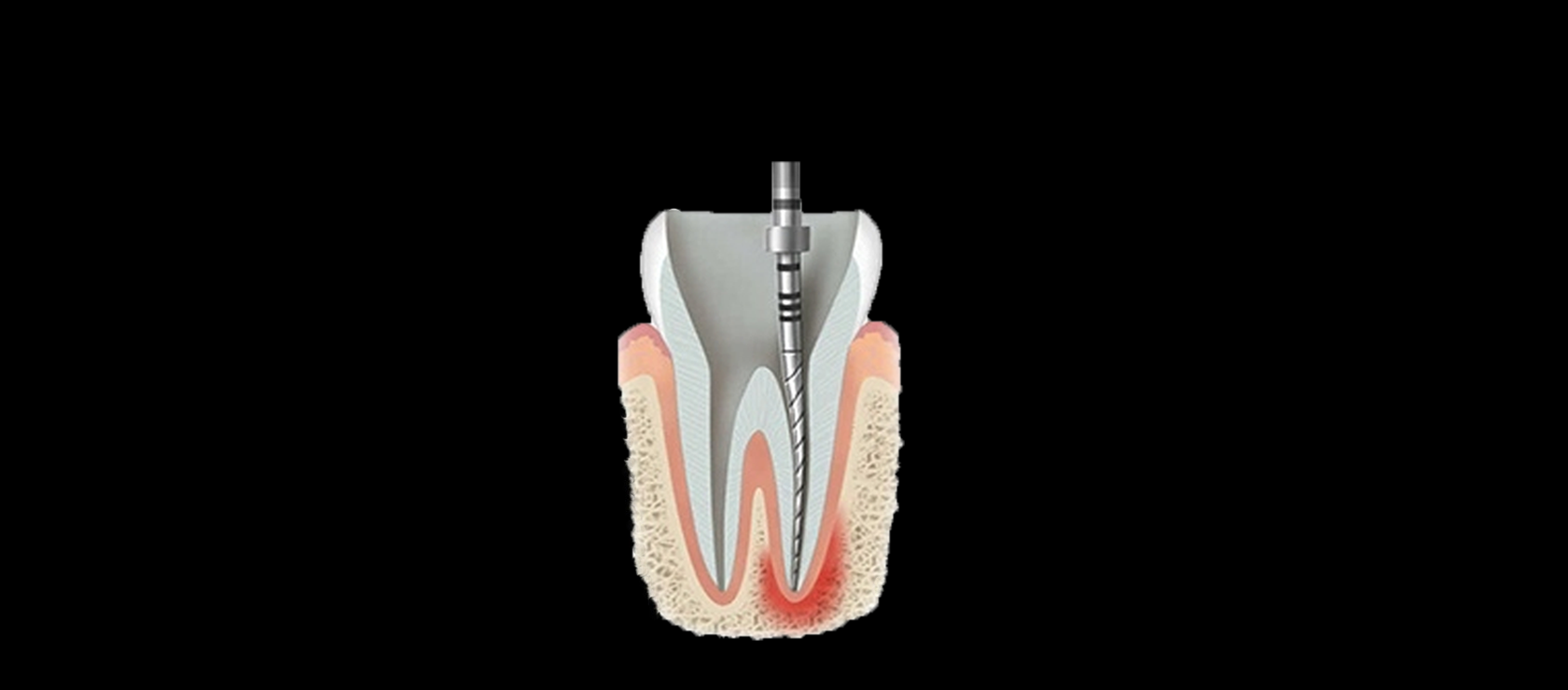 Root Canal: Step 2-Remove the Infected Pulp Inside Tooth in Happy Light Dental, Hawthorne, CA, 90250