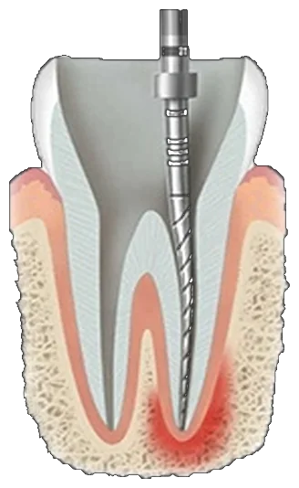 Opening the tooth and cleaning the canals