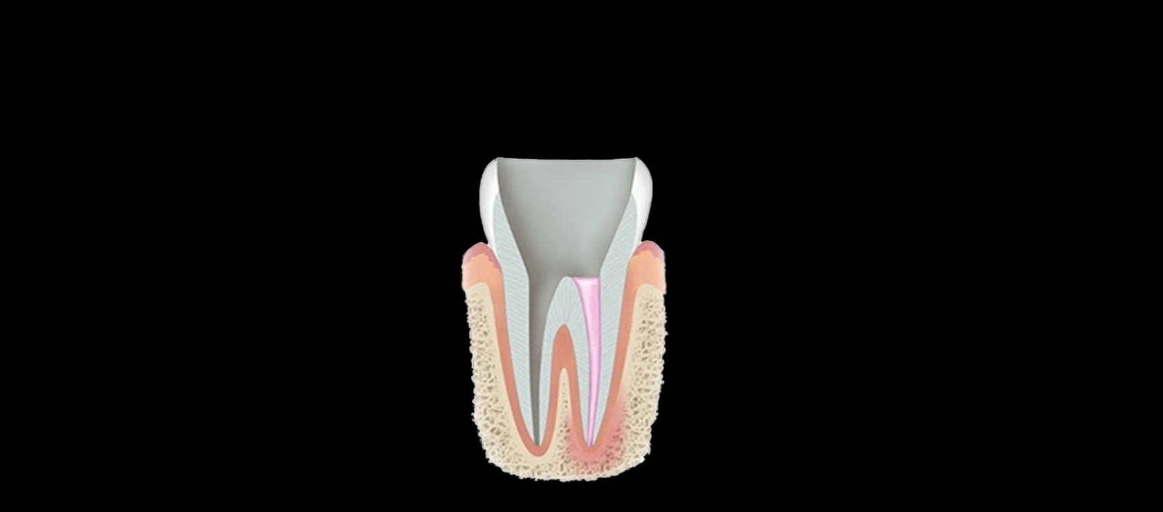 Root Canal: Step 3- Filling a New Root Filler in Happy Light Dental, Hawthorne, CA, 90250