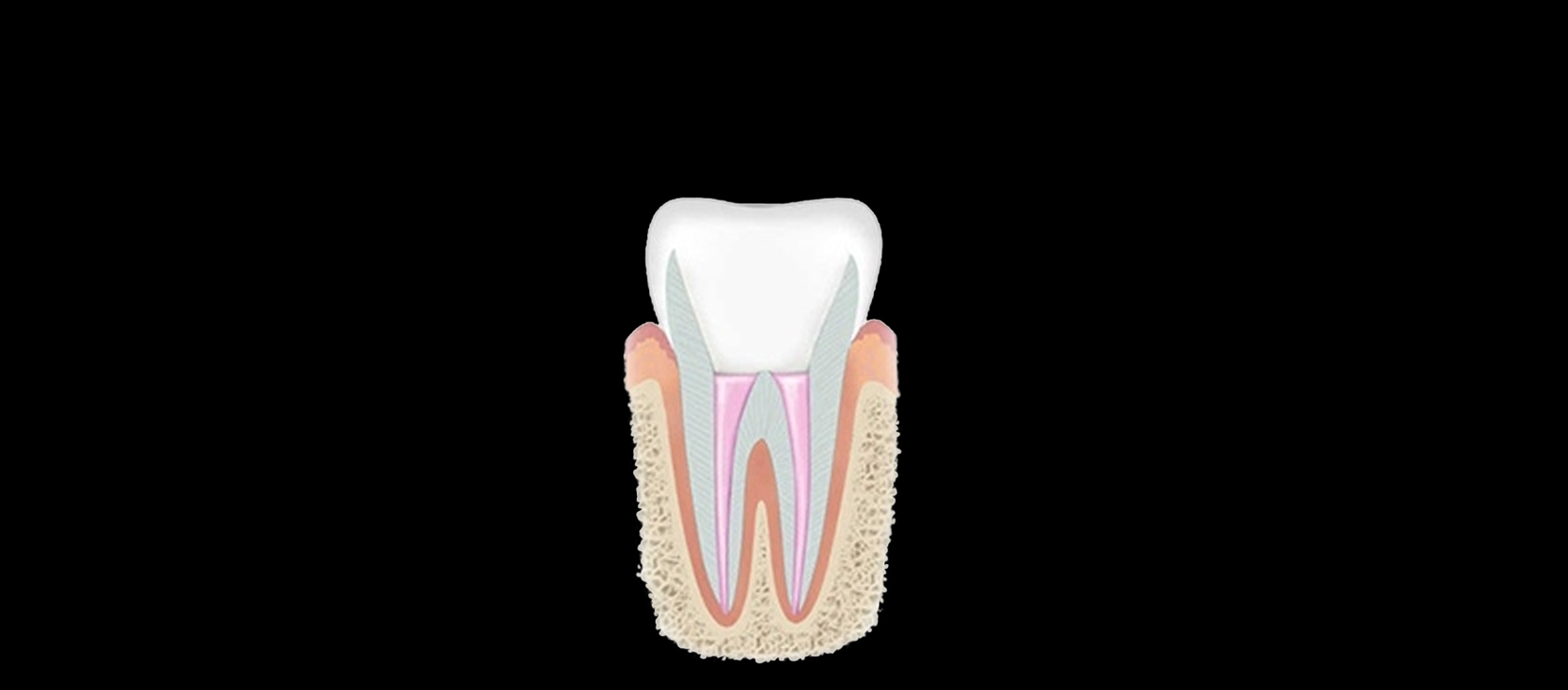 Root Canal: Step 4- Restoring the tooth in Happy Light Dental, Hawthorne, CA, 90250