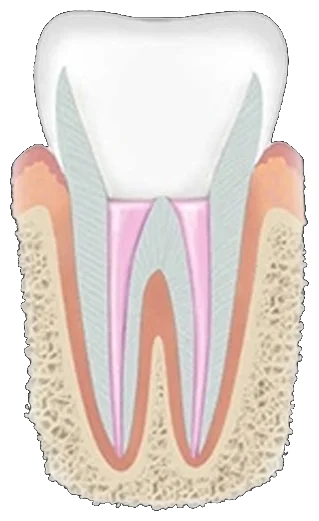 Crown placed over the treated tooth