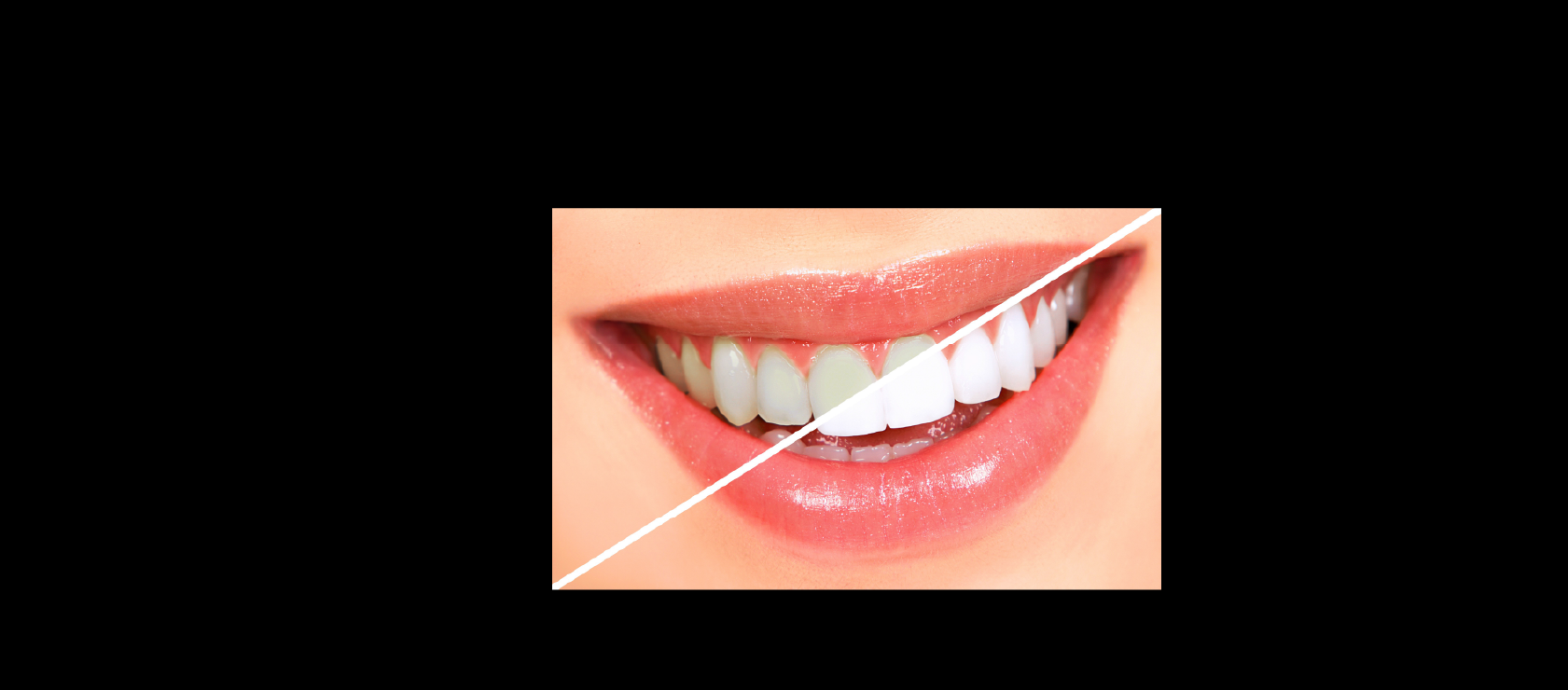 Teeth Whitening: Sample1 in Happy Light Dental, Hawthorne, CA, 90250