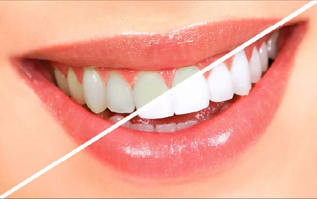 Before and after teeth whitening