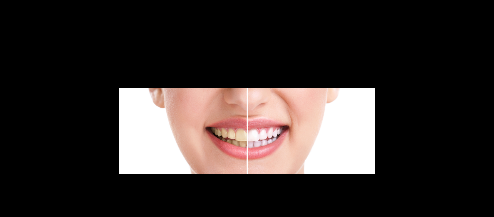 Teeth Whitening: Sample2 in Happy Light Dental, Hawthorne, CA, 90250