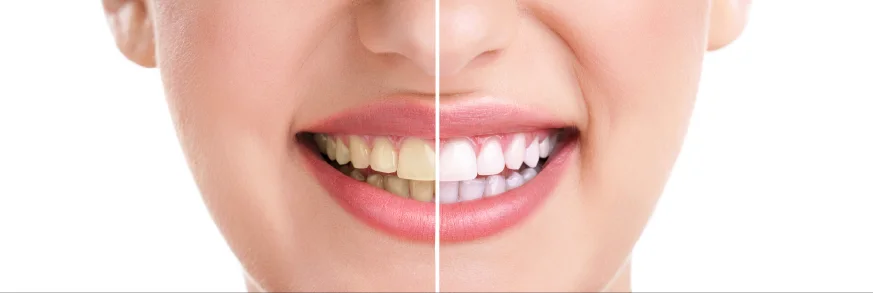 Before and after, split view