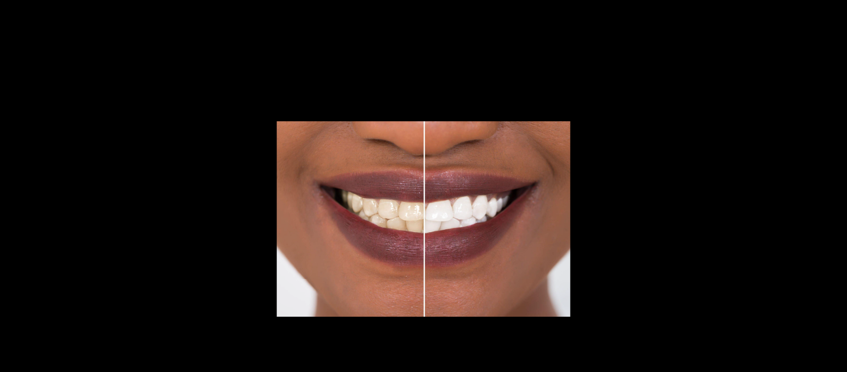 Teeth Whitening: Sample3 in Happy Light Dental, Hawthorne, CA, 90250