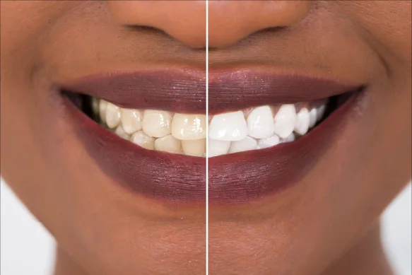 Even whitening result