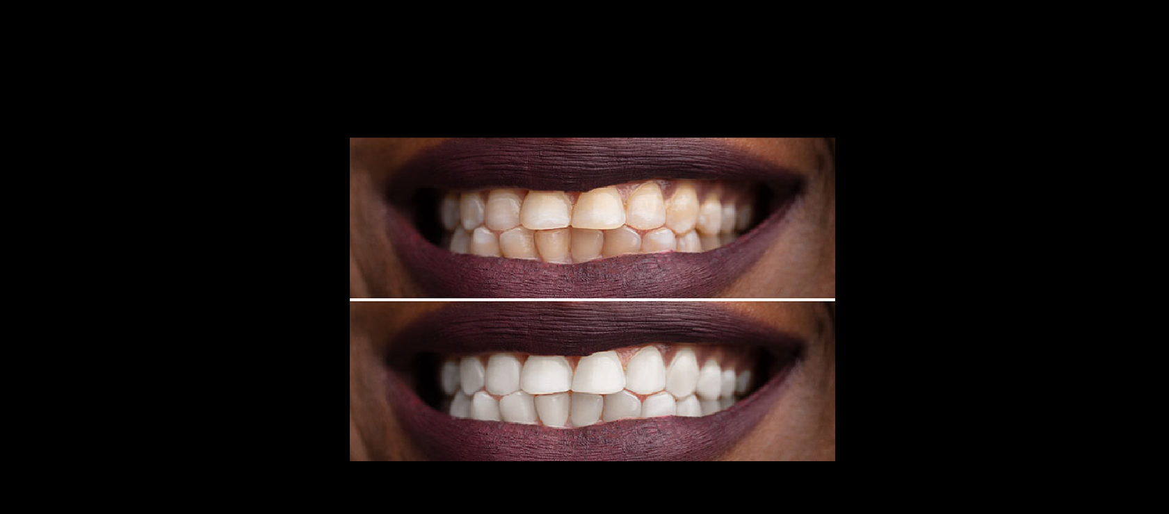 Teeth Whitening: Sample4 in Happy Light Dental, Hawthorne, CA, 90250