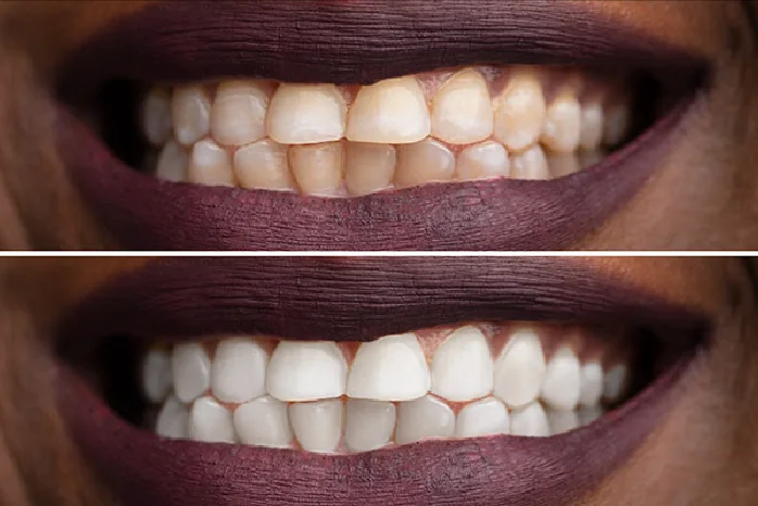 Before and after on darker teeth
